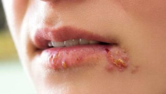 Infección por herpesvirus puede aumentar el riesgo de diabetes