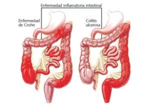 Control dolencias inflamatorias intestinales es difícil