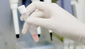 La saliva podría ayudar a predecir la evolución del cáncer de cabeza y cuello