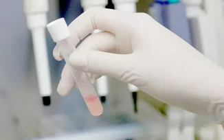 La saliva podría ayudar a predecir la evolución del cáncer de cabeza y cuello