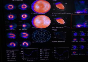 CEDIMAT realiza gammagrafía cardíaca con Regadenoson