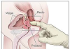 Eyaculación y cáncer de próstata: aclaraciones necesarias